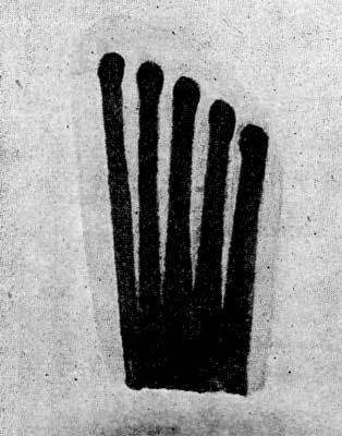 FIGURE 3.—SKETCH OF A BABY'S FOOT.