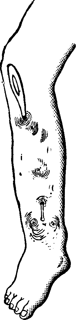 Illustration: Fig. 6. Necrosis of the tibia. A common probe is passed through the sinuses, or openings.