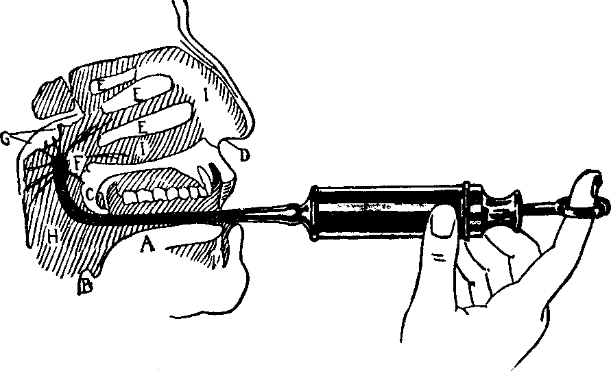 Illustration: Fig. 16. Use of the Post-nasal Syringe in the treatment of Post-nasal Catarrh.