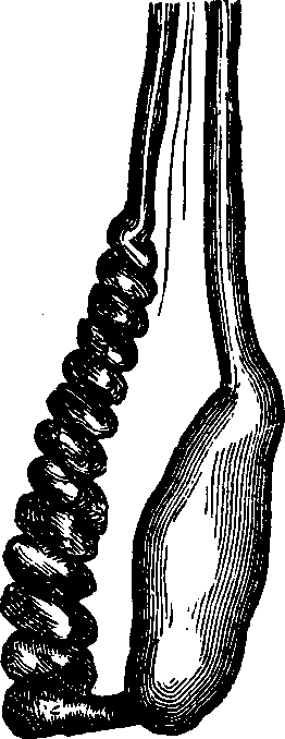 Illustration: Fig. 2. Testicle wasted from Varicocele. The enlarged and torturous veins are shown to be about as large as the testicle.