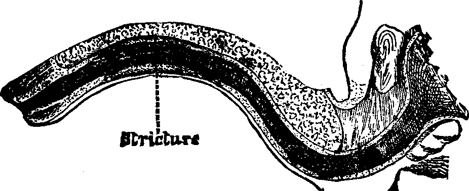 Illustration: Fig. 2. A Single Stricture of the Urethra.