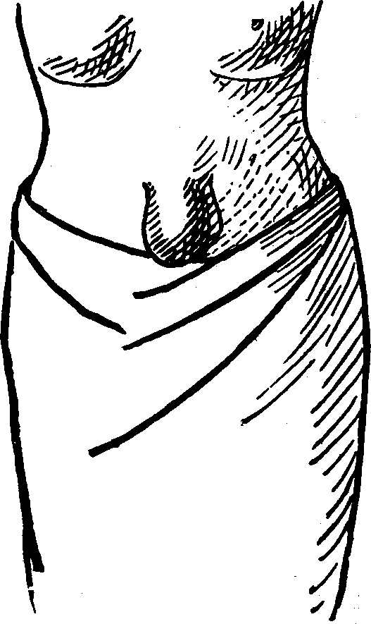 Illustration: Fig. 3.  UMBILICAL HERNIA.