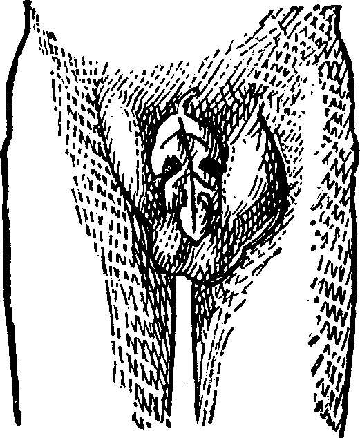 Illustration: Fig. 5.  This figure illustrates a Double Inguinal Hernia