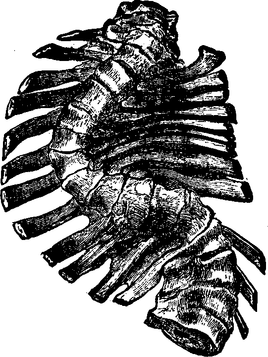 Illustration: Fig. 8. Lateral curvature in an advanced stage. 