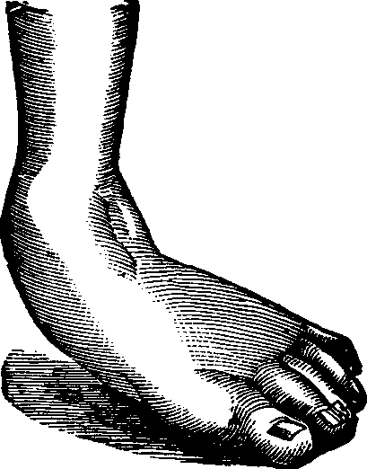 Illustration: Fig. 12. Talipes Valgus.