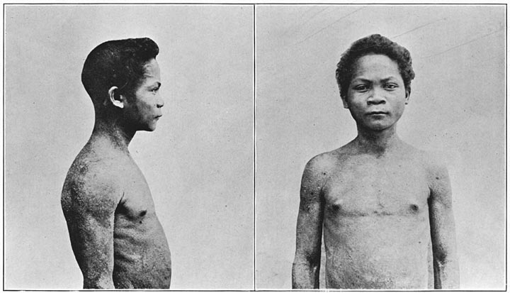 Negrito man of Zambales, mixed blood, showing skin disease.