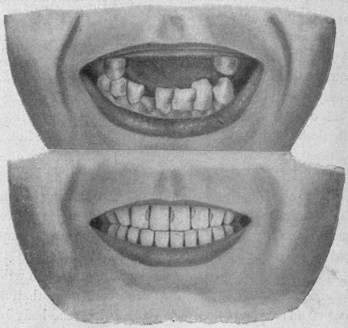 Bad and good teeth