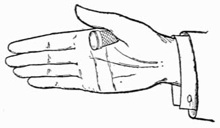 Fig. 38.—Thimble at Root of Thumb