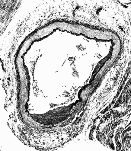 Fig. 2.—Cross section of a coronary artery, ×50, showing nodular sclerosis. Note the heaping up of cells in the intima, the fracture of the elastica, and the destruction of the media beneath the nodule. The primary lesion evidently was in the media. The thickened intima is the effort on the part of nature to heal the breach. At such places as shown here aneurysms may form. (Microphotograph.)