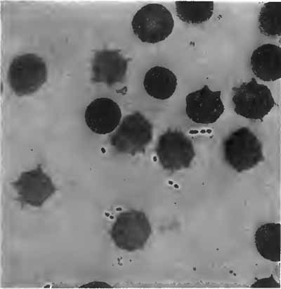Diplococcus pneumoniæ in the blood