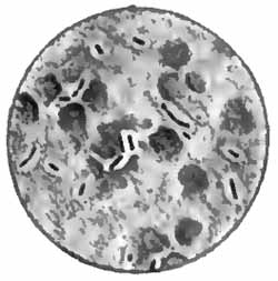 Friedländer's bacillus in pus