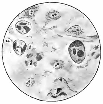 Diplococcus pneumoniæ
