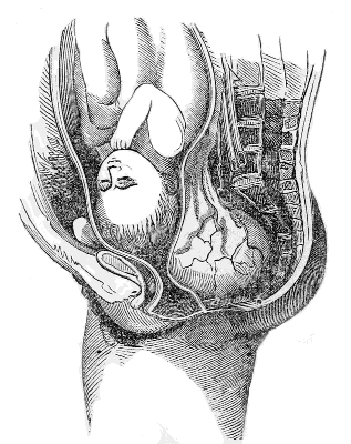 Case of Tumor