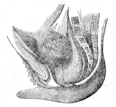 Case of Polypus