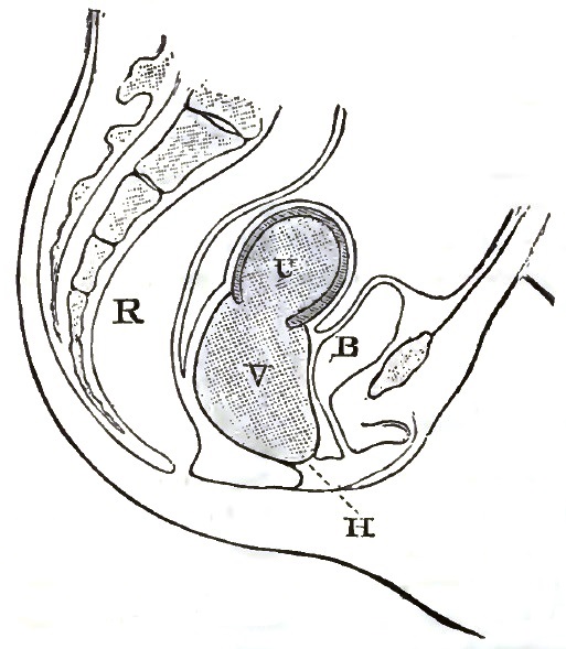 Imperforate hymen