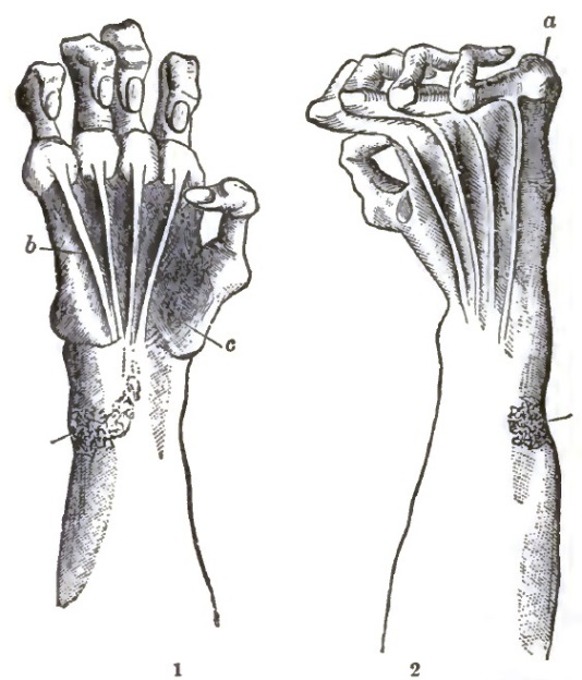 Deformity of hand