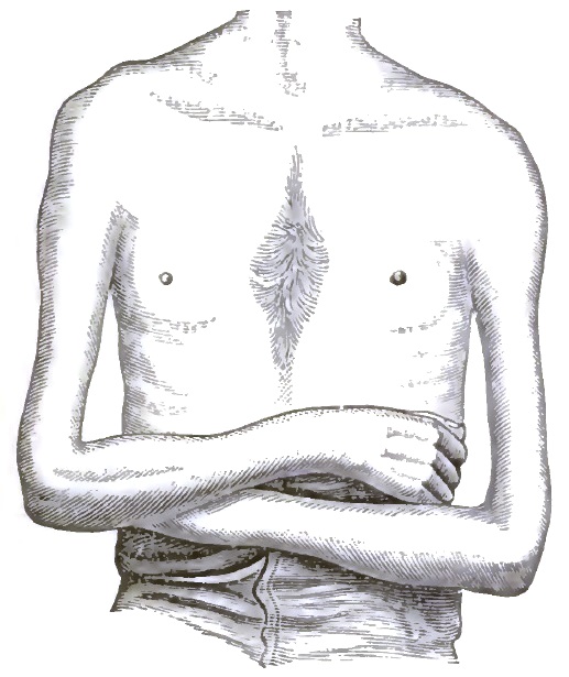 Atrophy of right deltoid and arm