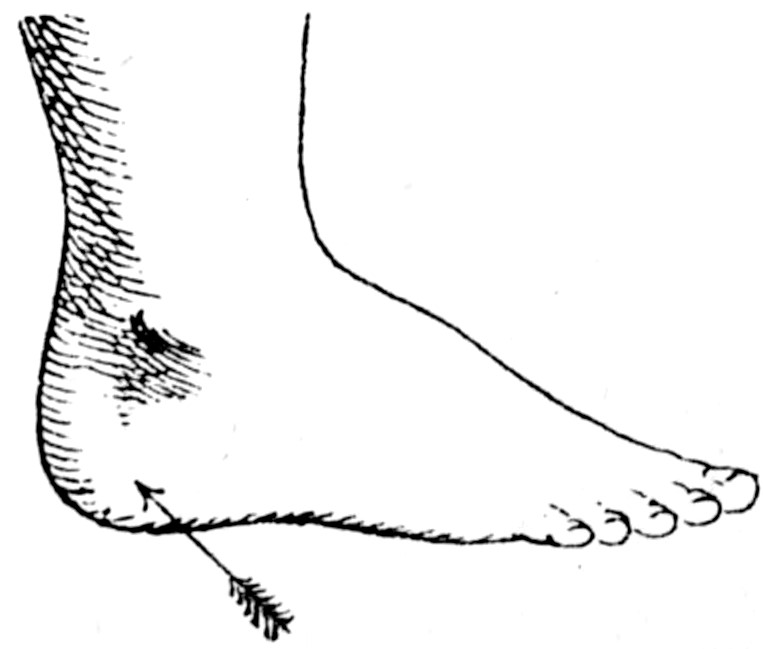 Foot with arrow pointing to the heel