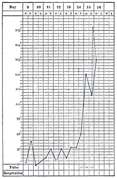 Temperature chart of temporal lobe tumor