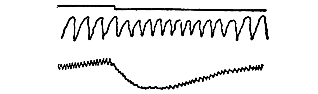 Another polygraph record.         It is very similar to the previous example, except that the         waves in the middle line shrink more noticeably at the         one-third point, and take longer to return to their previous         size. Likewise, the dip in the bottom line is deeper and         wider.